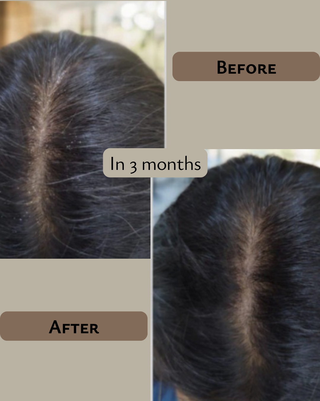 PRAKRTA Ayurvedic Hair Massage Oil – Dandruff Control & Hair Growth Treatment