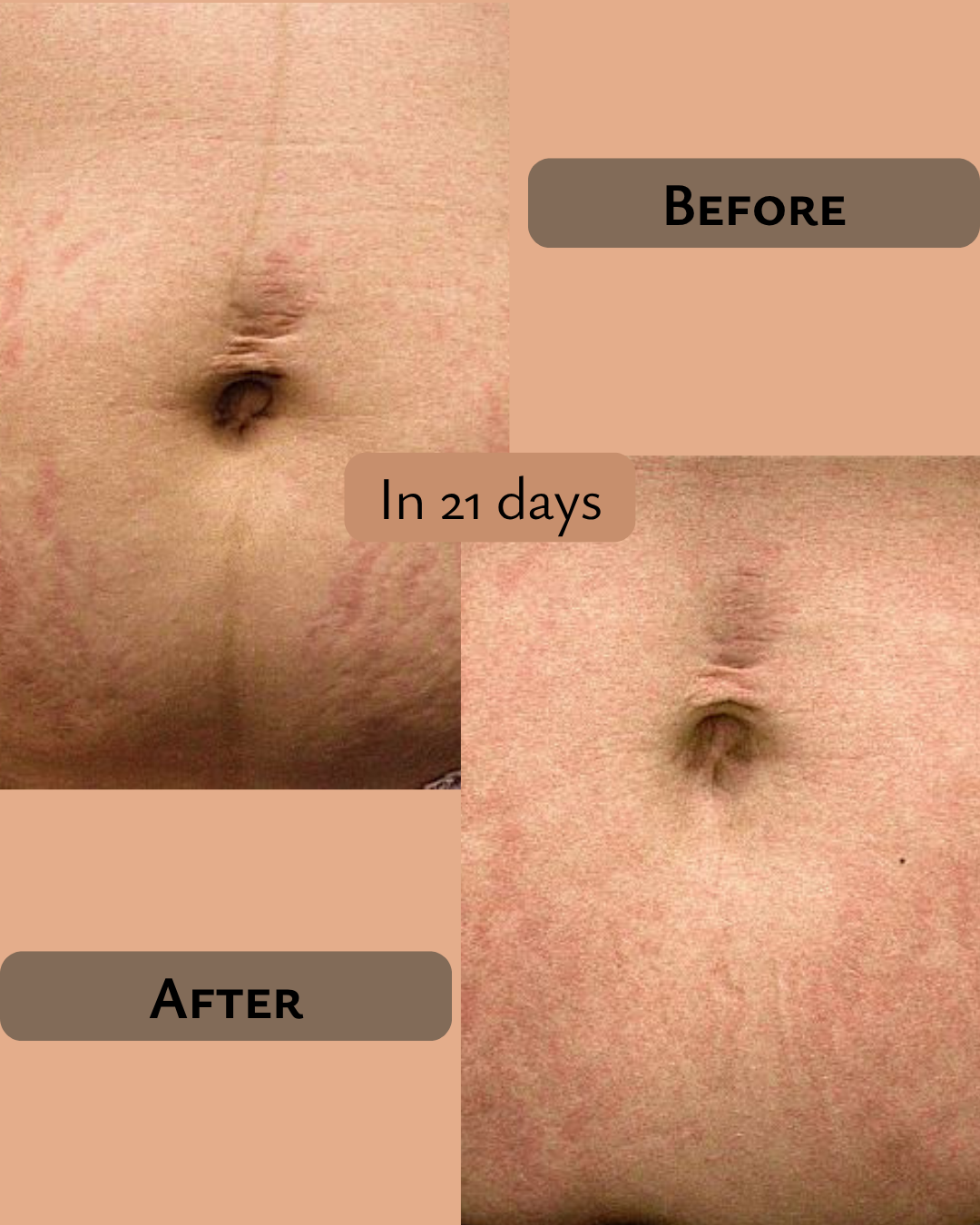 PRAKRTA Ayurvedic Stretch Mark Removal Oil – Fade Scars & Boost Skin Elasticity