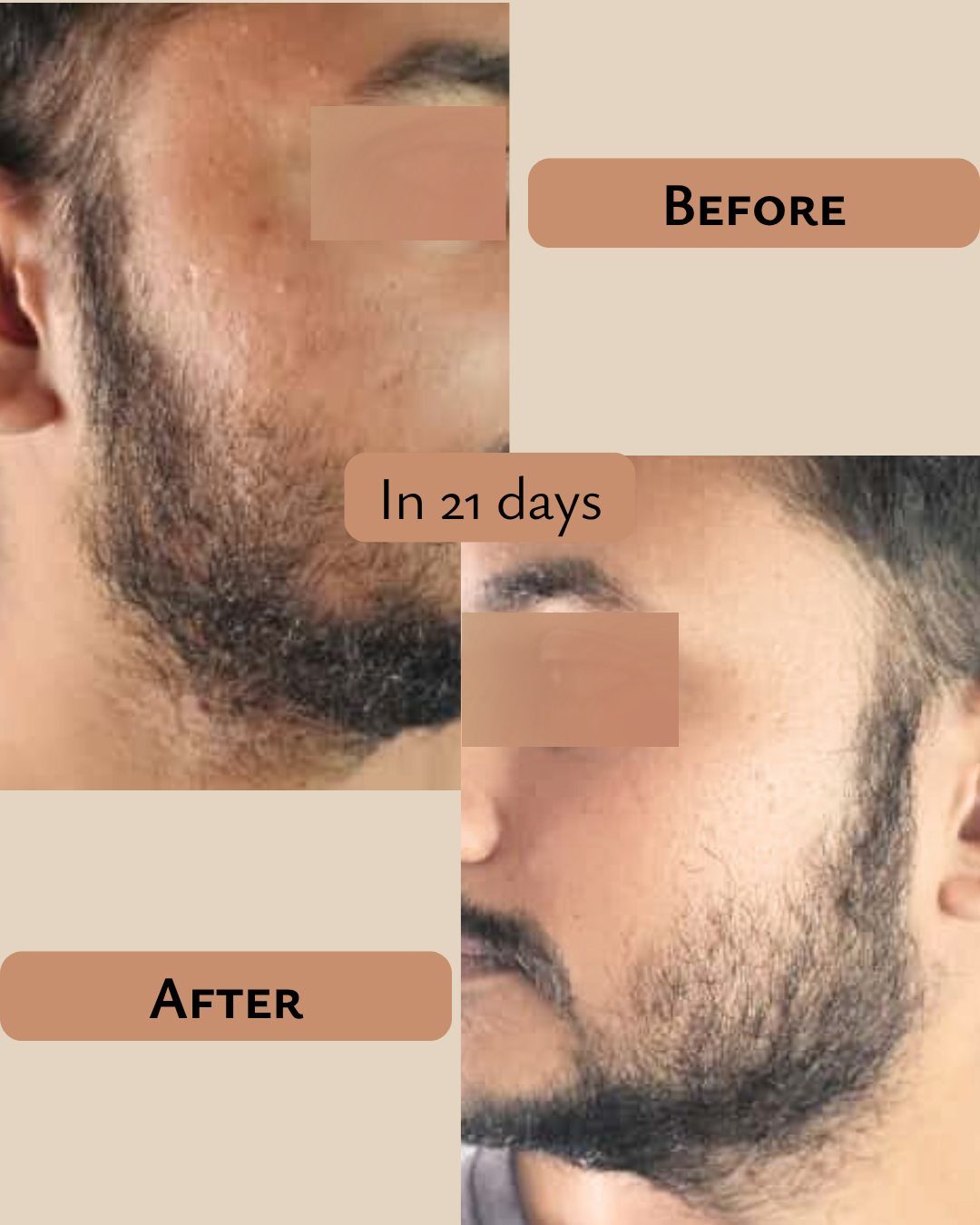 PRAKRTA Ayurvedic Pigmentation Removal Oil – Fade Tough Dark Spots, Even Skin Tone