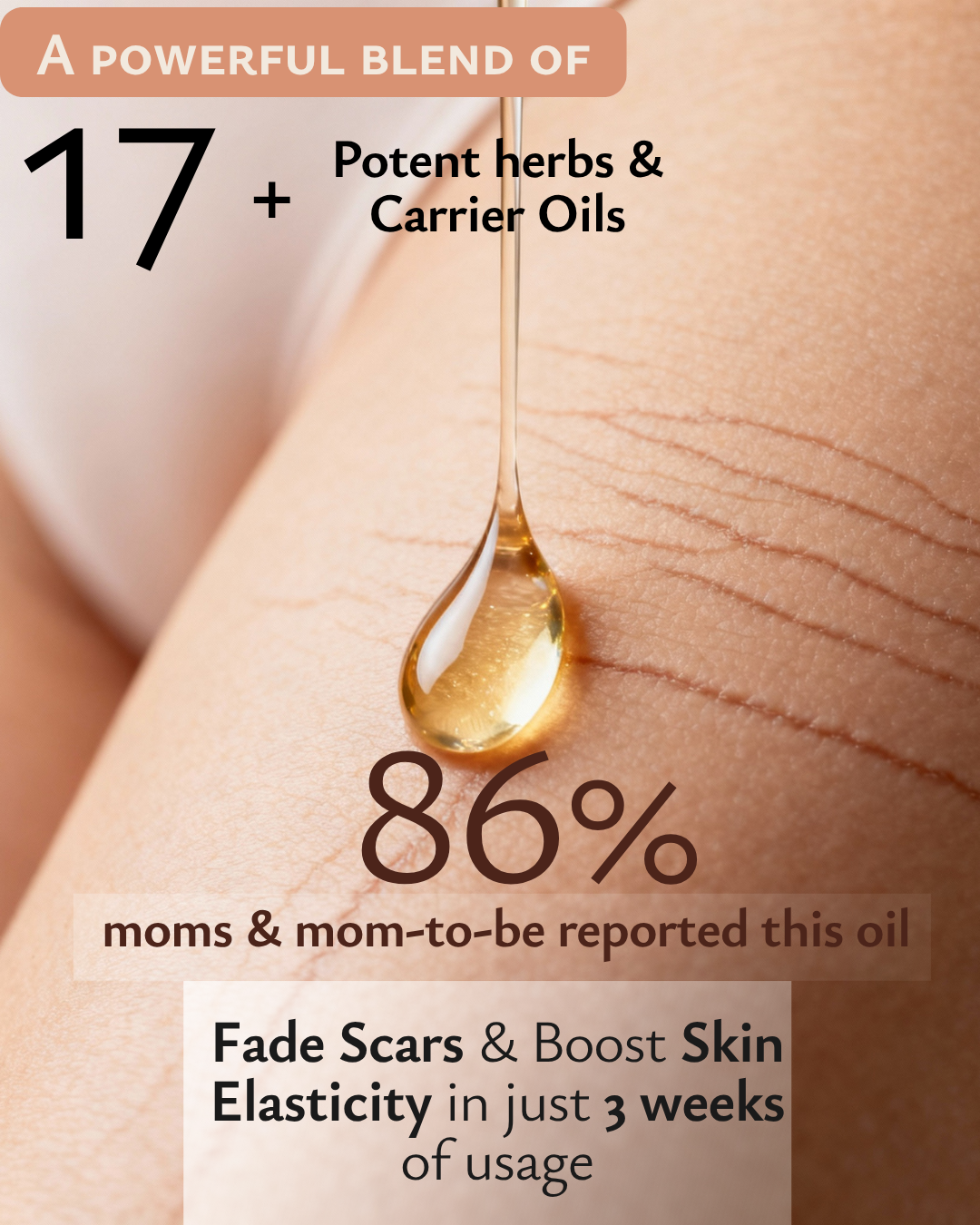 PRAKRTA Ayurvedic Stretch Mark Removal Oil – Fade Scars & Boost Skin Elasticity